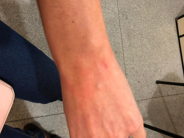 A vítima mostrando o braço após o incidente da manhã na prefeitura / Divulgação