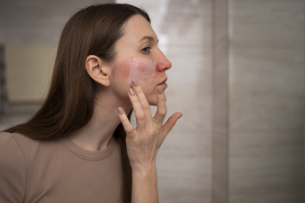 Notícia - Rosácea: condição de pele piora no inverno e pode ser confundida com acne