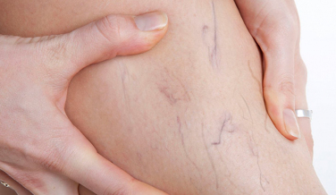 Notícia - Cirurgia, laser ou espuma? Qual o tratamento ideal para varizes?