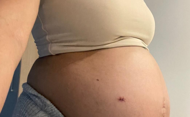 Amor além do útero: casal luta pela vida da filha ainda no ventre da mãe