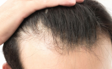 Como é feito o transplante capilar?