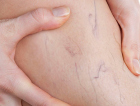 Cirurgia, laser ou espuma? Qual o tratamento ideal para varizes?