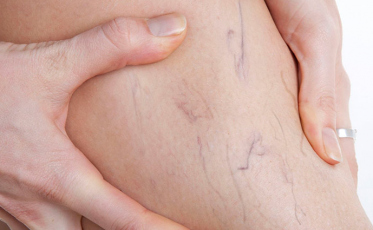 Cirurgia, laser ou espuma? Qual o tratamento ideal para varizes?