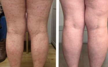 Psoríase atinge mais de 5 milhões de brasileiros e ainda carrega o peso do preconceito