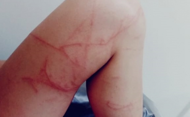 Banhista sofre grave queimadura em Jaguaruna