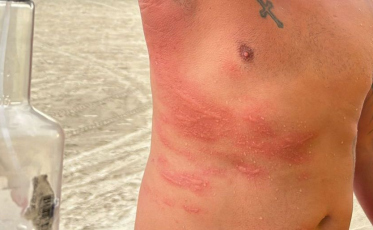 Queimaduras por águas-vivas têm alta de 70% na região