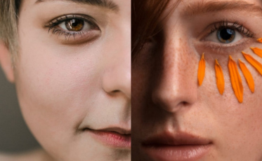 Olheiras têm solução: entenda as causas, tipos e tratamentos