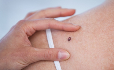 Câncer de pele causa mais de 30 mil mortes e quase 400 mil internações hospitalares no Brasil, em dez anos