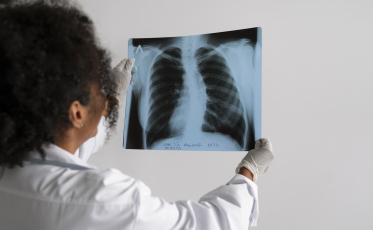 Programa da Vigilância em Saúde de Criciúma atua prevenção e tratamento da Tuberculose