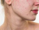 Mitos e verdades sobre a acne