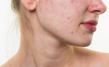 Mitos e verdades sobre a acne