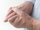 Os cuidados para evitar a artrose nas mãos