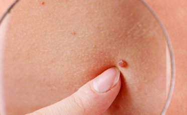 Saiba a diferença entre os tipos do câncer de pele, que atingem 180 mil por ano