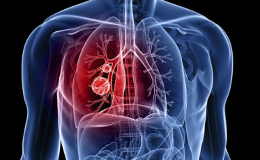 Câncer de pulmão deve atingir 31 mil pessoas em 2019