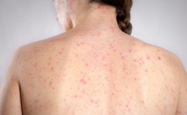 O que é o sarampo? Eu posso pegar?