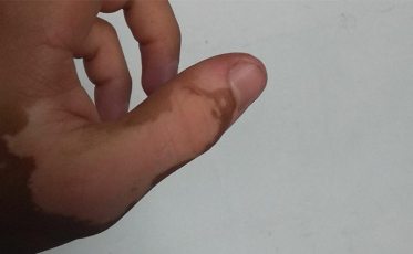 Vitiligo: Doença pode atingir 1% da população