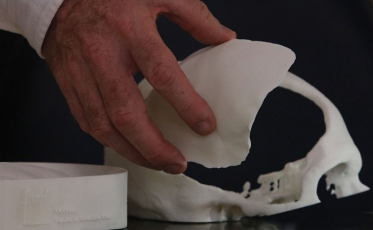 Brasileiros desenvolvem tecnologia de reconstrução craniana
