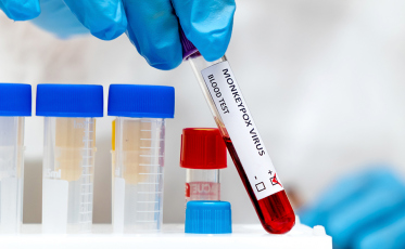 Santa Catarina confirma a primeira morte por Monkeypox; vítima é um jovem de 23 anos