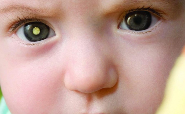 Retinoblastoma: diagnóstico precoce é a chave para tratamento