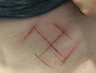 Caso de jovem que teve suástica marcada na barriga foi automutilação, segundo laudo