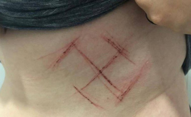 Caso de jovem que teve suástica marcada na barriga foi automutilação, segundo laudo